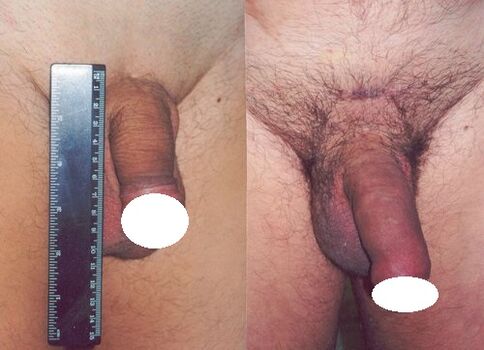 Penis before and after increasing